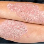 Psoriasis
